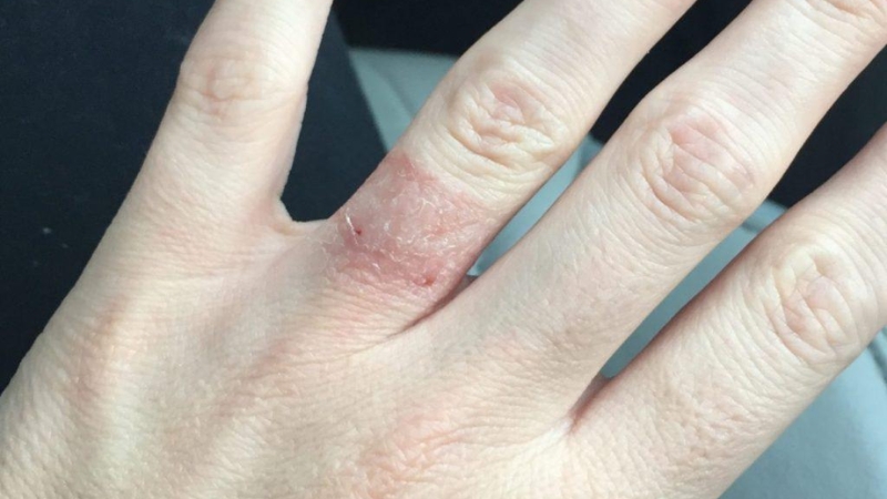 Sử dụng chất bôi trơn để tháo nhẫn nhanh chóng hơn